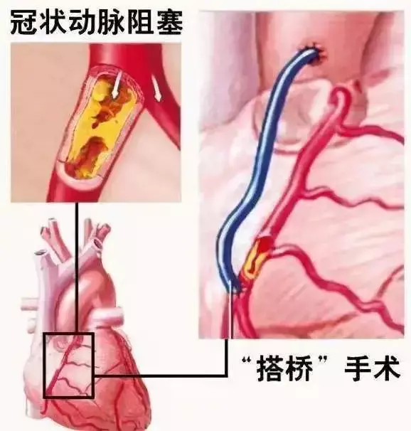 详解重疾险中最高发的6种重疾，占比超过80%！